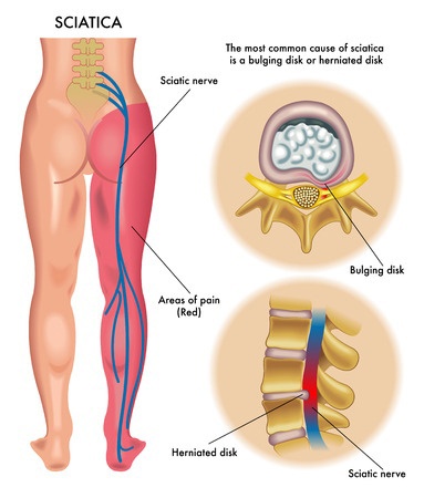 Electrotherapy for Sciatic pain