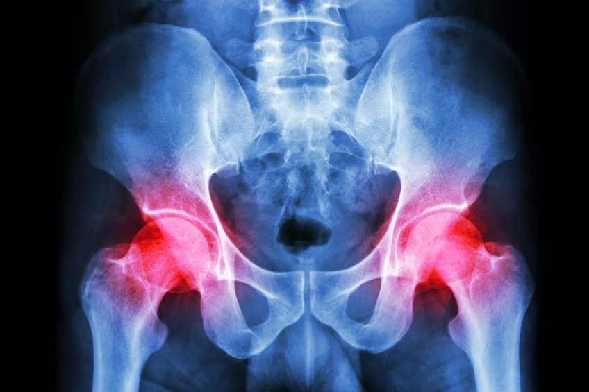 Osteoarthritis Hip pain relief with TENS Units